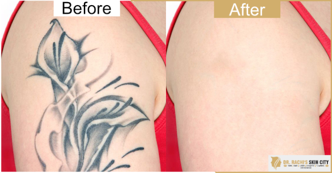 Tips for Faster, Pain and Scar-Free Laser Tattoo Removal Healing